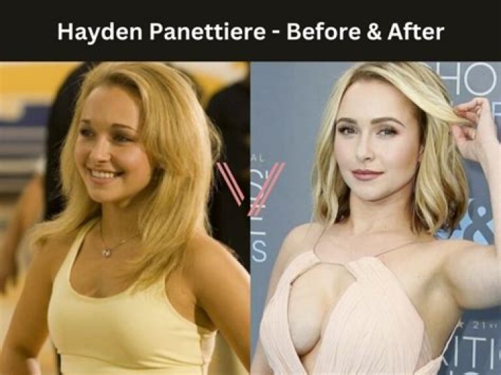 Hayden Panettiere Breast Implants Plastic Surgery Before and After