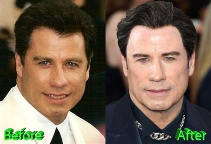 John Travolta Plastic Surgery Before and After