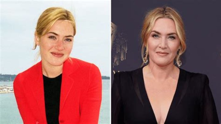 Kate Winslet Plastic Surgery: Embracing Age and Defying Hollywood Norms
